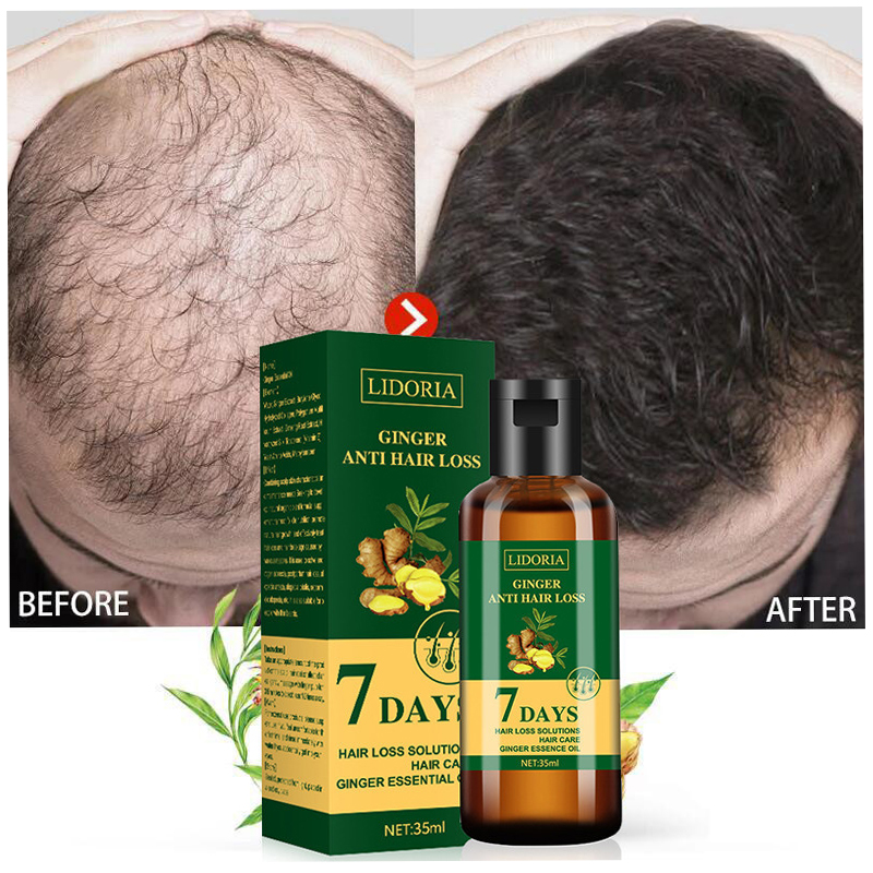 Ginger Hair Growth Essential O - đánh giá và giá Hair Care Essence Oil Spray